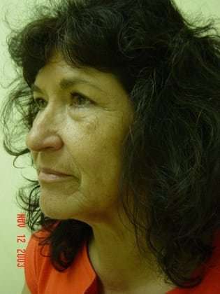 Facelift Before & After Patient #372