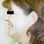 Facelift Before & After Patient #384