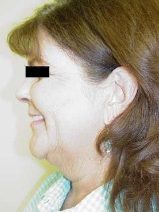 Facelift Before & After Patient #384