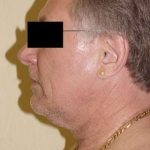 Facelift Before & After Patient #395