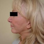 Facelift Before & After Patient #416