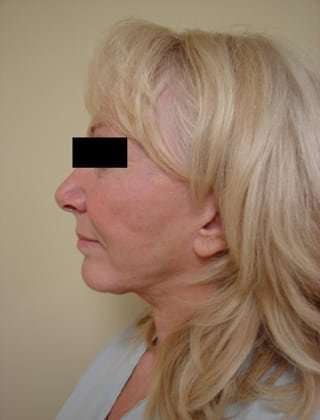 Facelift Before & After Patient #416