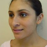 Rhinoplasty Before & After Patient #263