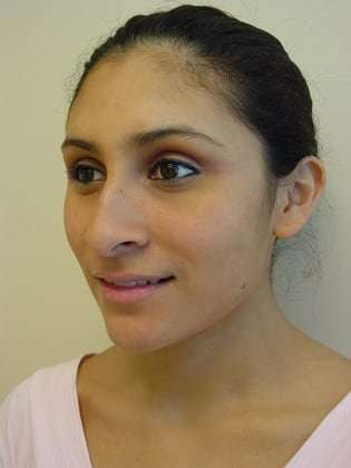 Rhinoplasty Before & After Patient #263