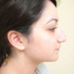 Rhinoplasty Before & After Patient #230
