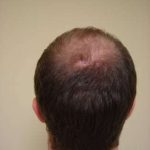 Hair Transplants Before & After Patient #328