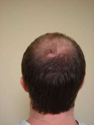 Hair Transplants Before & After Patient #328