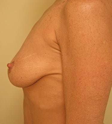 Breast Lift Before & After Patient #555