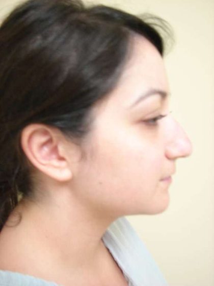 Rhinoplasty Before & After Patient #230