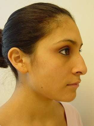Rhinoplasty Before & After Patient #263